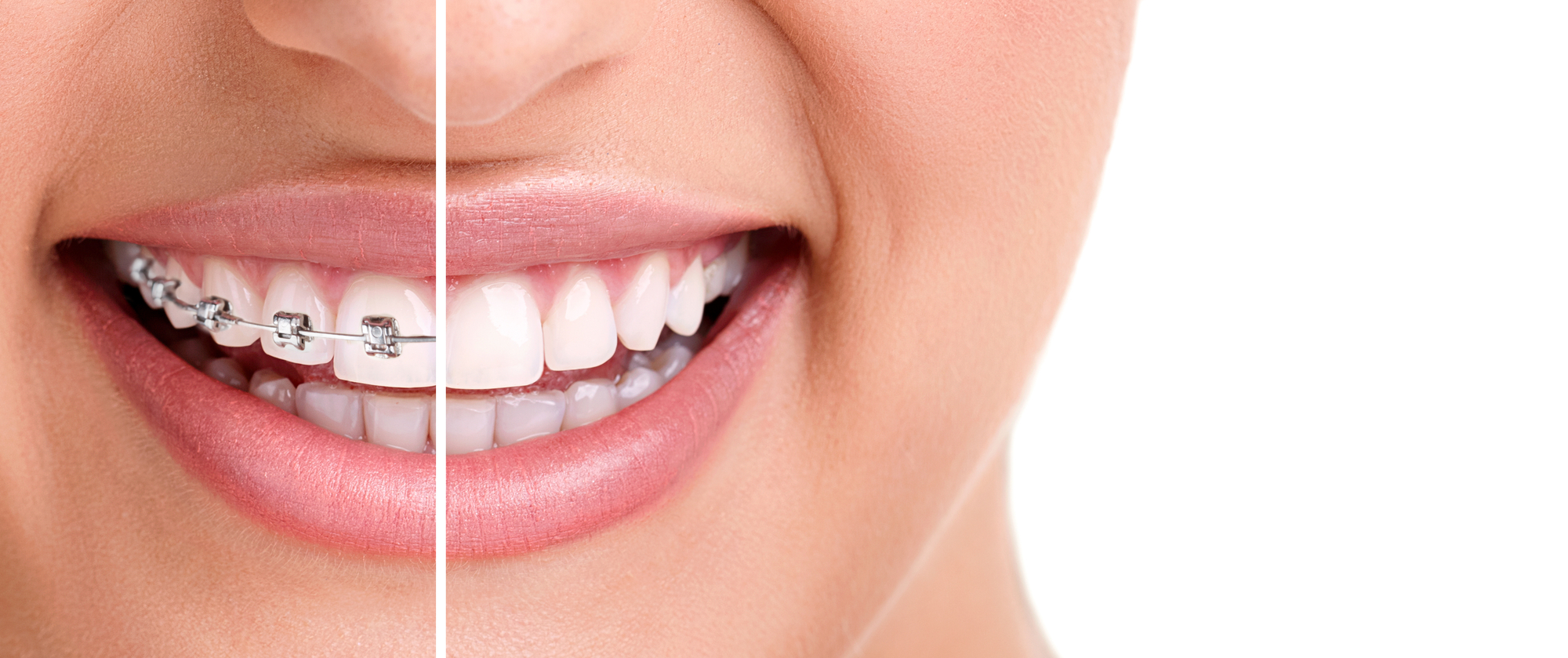 Clear-aligner vs Braces for Adults